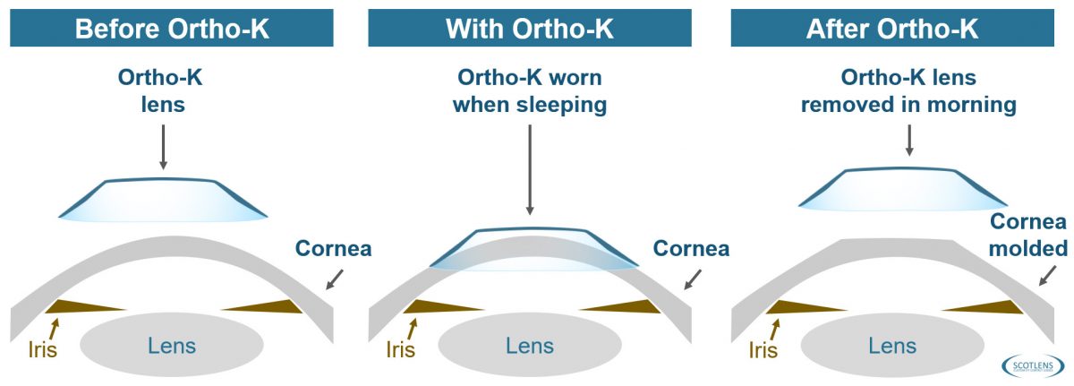 How to grow the Ortho-K market? Call them ‘Night Lenses’ - Scotlens.